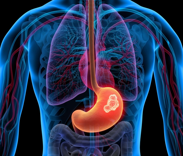 Stomach tumour