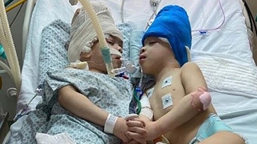 Twins Bernardo (L) and Arthur Lima have been successfully separated