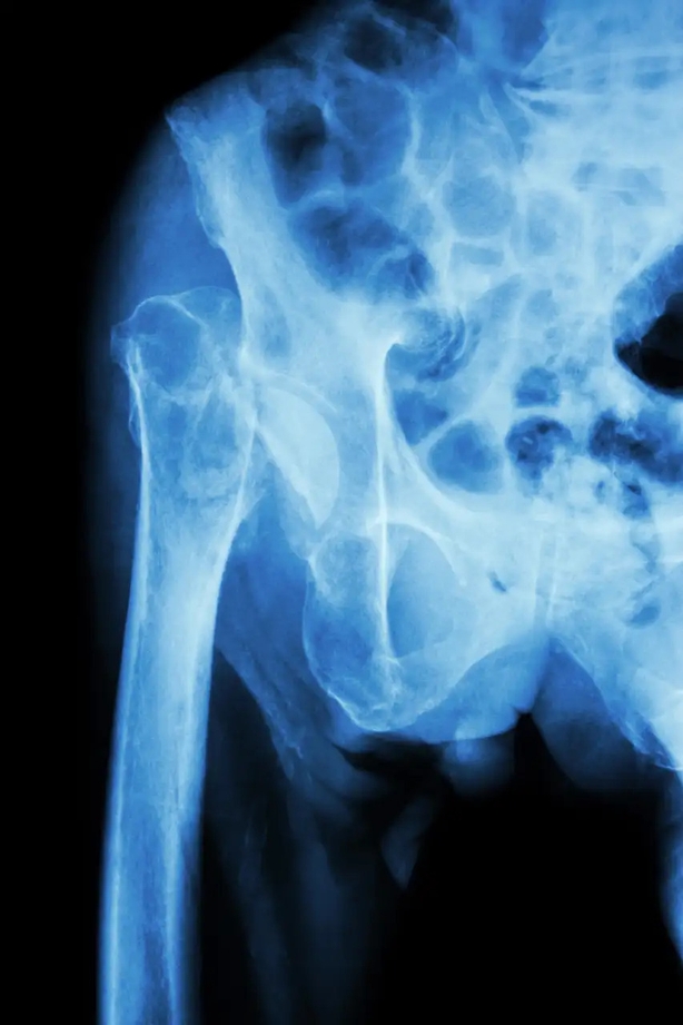 A new study says a veggie diet can make your bones and joints more fragile (Alamy/PA)