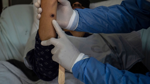 A doctor checks on a patient with sores caused by a monkeypox (File image)