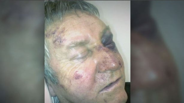 McAllister's injuries