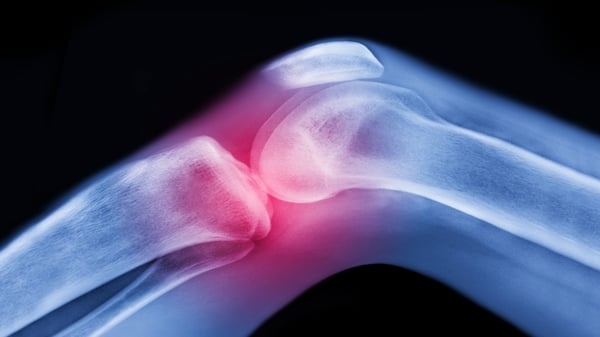 'Osteoporosis is preventable and it's also treatable if you find the cause'. Photo: Getty Images