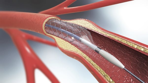 Could metamaterials deliver better heart stents for patients? Photo: Getty Images