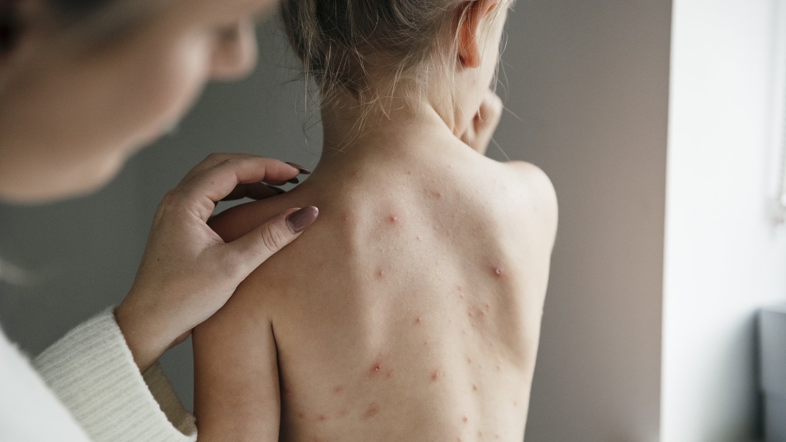 Significant increase in chickenpox hospitalisations