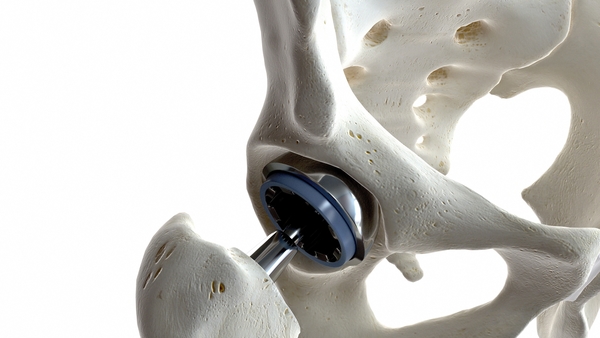 'There are two main reasons for implant failure from a materials scientist perspective'. Photo: Getty Images