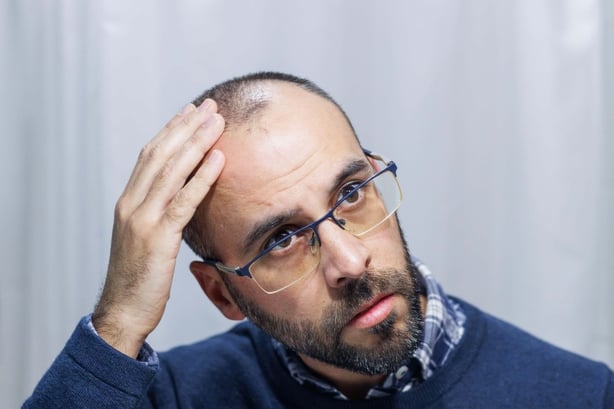 A man with hair loss on his head