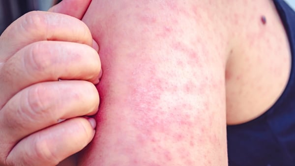 Only one case of measles has been confirmed this year in Ireland after a man died earlier this month (file image)