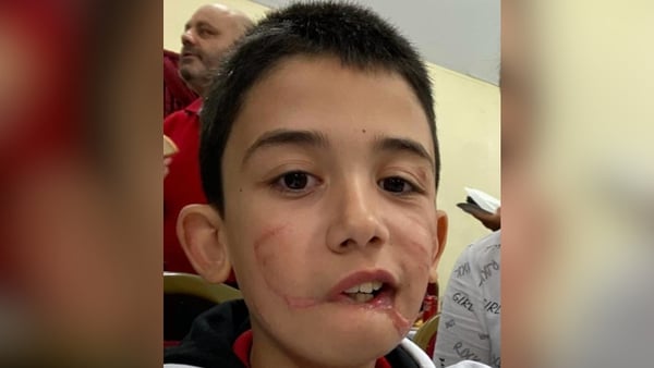 Alejandro Mizsan, who is now aged 11, was attacked by an XL Bully dog while playing on a green with friends in 2022