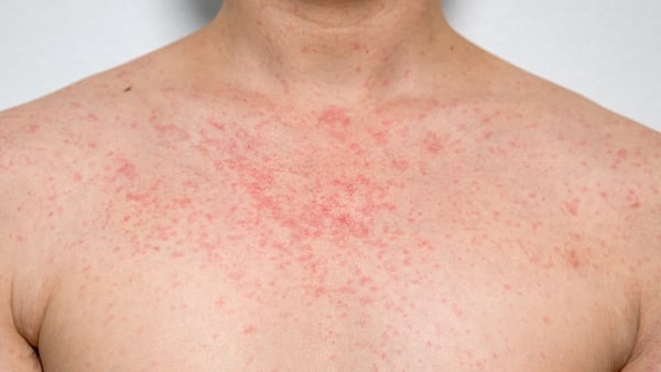 Signs of measles include a rash, which usually appears on head and neck first and spreads