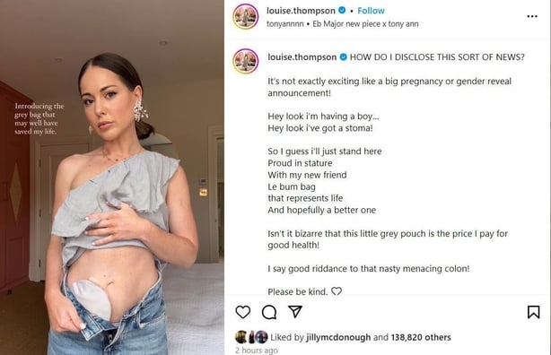 Louise Thompson Reveals She Has A Stoma Bag