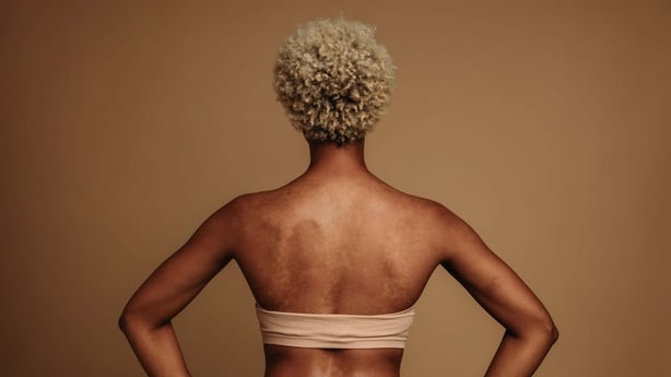 Womans back shoes sun spot marks
