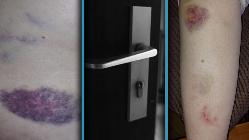 The parents of the woman complained to the HSE when it found extensive bruising on her buttocks and thigh area.