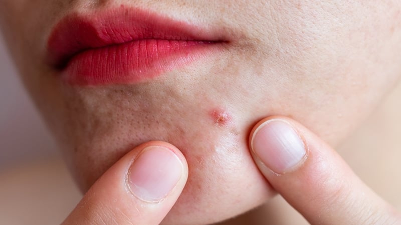 "Acne affects 35% of women and 20% of men" "Acne affects 35% of women and 20% of men"